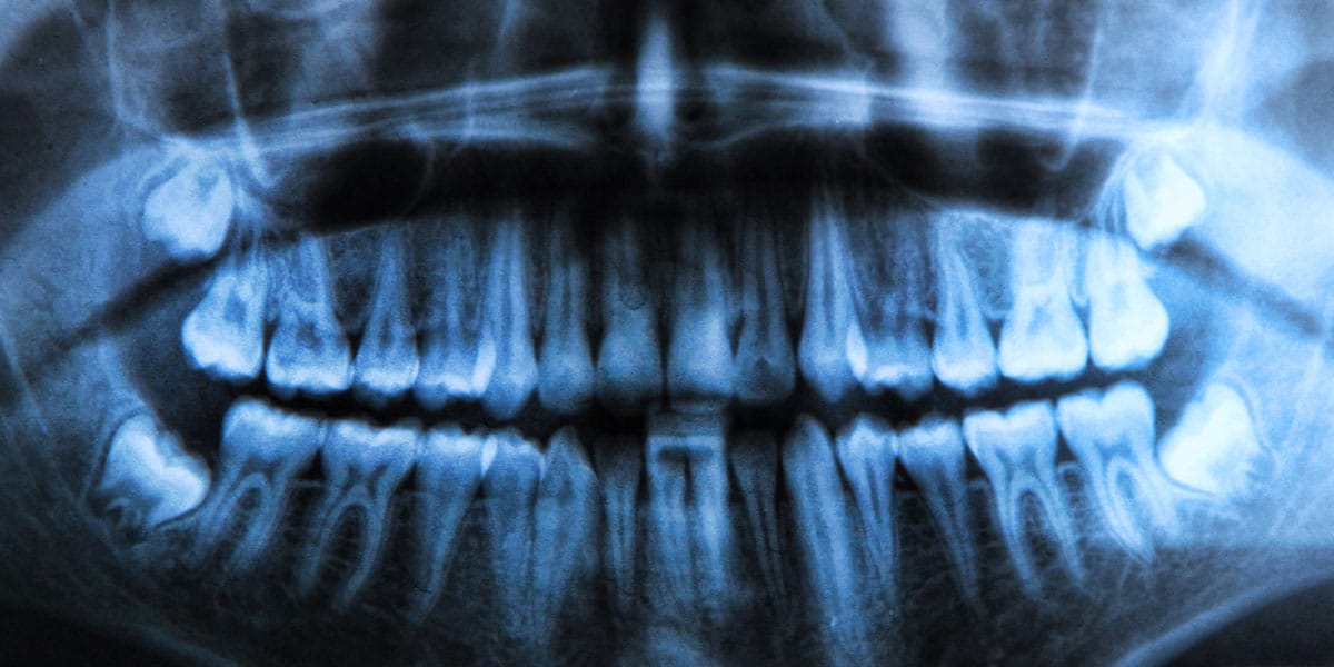 xray showing impacted wisdom teeth