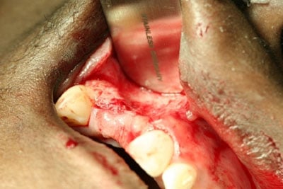 Bone Grafting Example