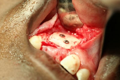 Bone Grafting Example After