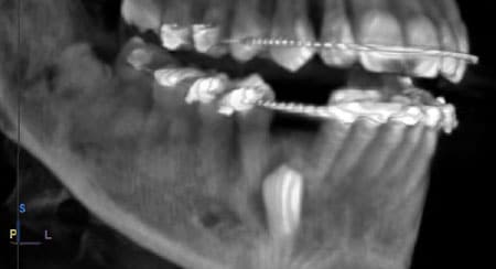 Impacted Teeth Example 1