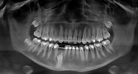 Impacted Teeth Example 2