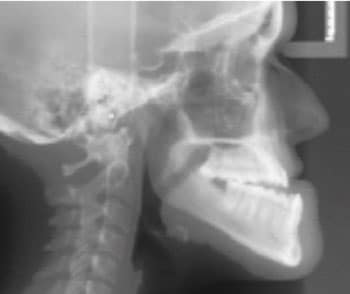 Orthognathic Jaw Surgery Before