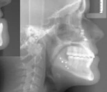 Orthognathic Jaw Surgery After